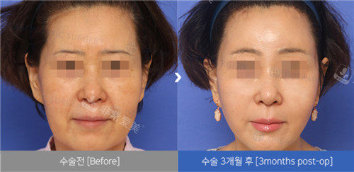 韩国dream做面部拉皮手术好吗？尤其是口碑重点分享一下！