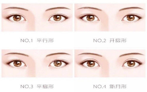 眼睛整形類(lèi)型圖示 眼睛整形類(lèi)型圖示
