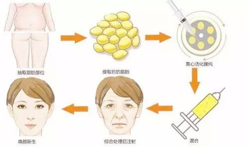 自體脂肪填充卡通圖過(guò)程圖示 自體脂肪填充卡通圖過(guò)程圖示