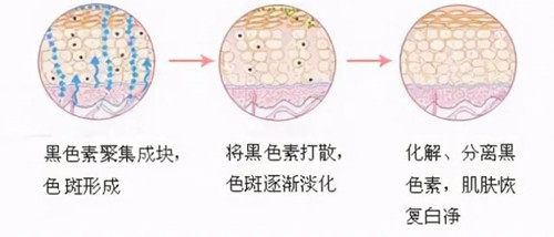 激光祛斑圖示 激光祛斑圖示
