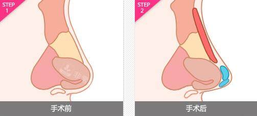 韓國NJH盧鐘勛整形隆鼻手術(shù)卡通圖