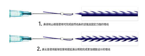 韩国美尔韩医院鼻整形埋线线体