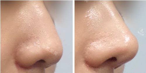 韩国美尔韩医院鼻整形优势明显,埋线施术打造自然鼻部线条
