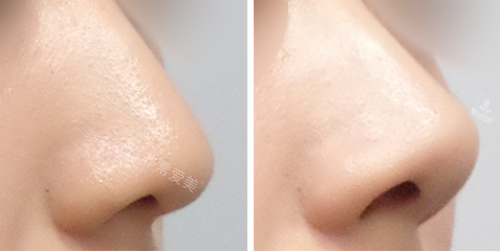韩国美尔韩医院鼻整形优势明显,埋线施术打造自然鼻部线条