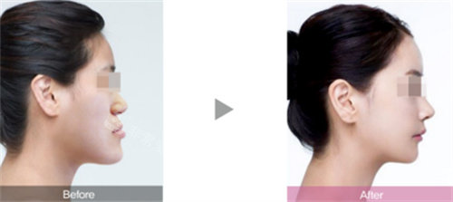 韩国伊美芝整形面部轮廓真人实例专场，前后对比变化惊人!