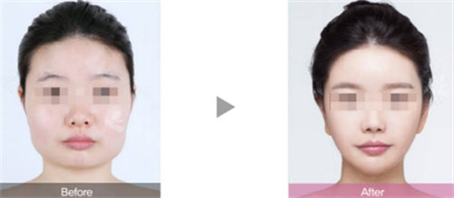 韩国伊美芝整形改脸型对比图