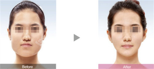 韩国伊美芝整形面部轮廓女性例子图