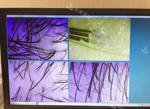南昌佳美植發(fā)科毛囊檢測 南昌佳美植發(fā)科毛囊檢測