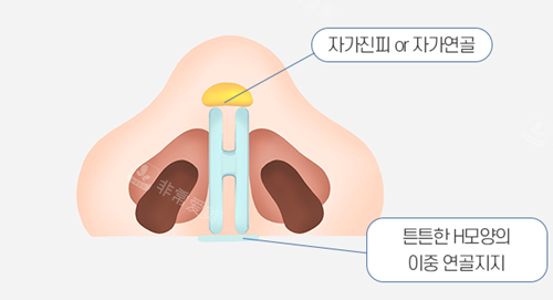 韩国温度整形独有的H-double支撑结构