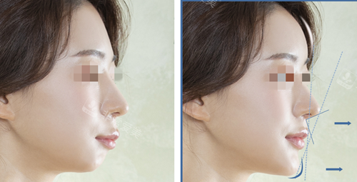韩国温度整形单纯隆鼻和同时进行人中/短下巴矫正区别在此