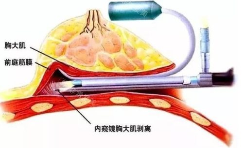 內(nèi)窺鏡隆胸示意圖