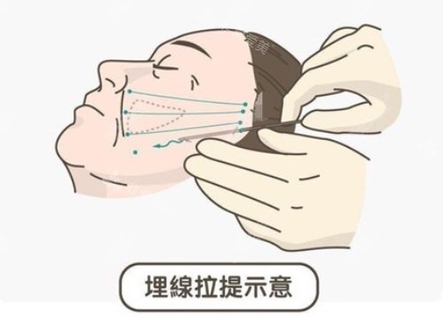 埋线提拉示意图 埋线提拉示意图