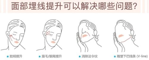 埋线提升可解决的问题 埋线提升可解决的问题