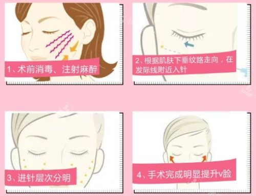埋线提升详细过程图 埋线提升详细过程图