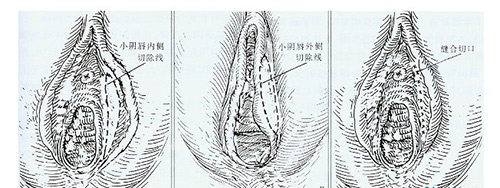 小阴唇整形示意图