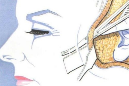 面部拉皮手术操作示意图