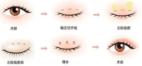 雙眼皮手術(shù)示意圖 雙眼皮手術(shù)示意圖