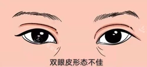 雙眼皮形態(tài)不佳示意圖 雙眼皮形態(tài)不佳示意圖
