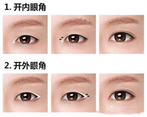 開內(nèi)眼角和開外眼角 開內(nèi)眼角和開外眼角