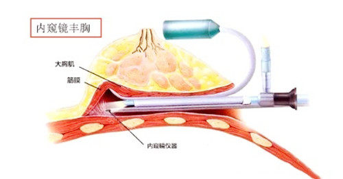內(nèi)窺鏡豐胸圖示 內(nèi)窺鏡豐胸圖示