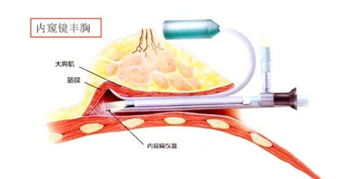 内窥镜丰胸图示