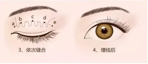 埋線雙眼皮示意圖