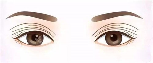 多層雙眼皮修復(fù)