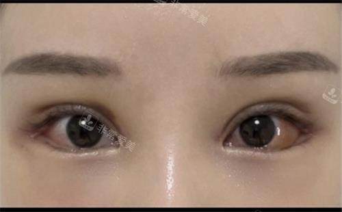 韓國迪美整形醫(yī)院雙眼皮修復(fù)手術(shù)后