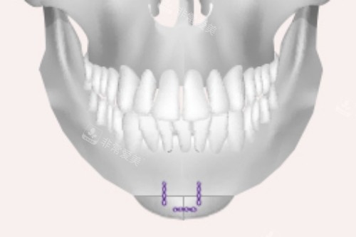 下巴手術(shù)做完后的模擬圖