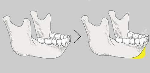 韩国NJH卢钟勋整形下巴垫假体示意图