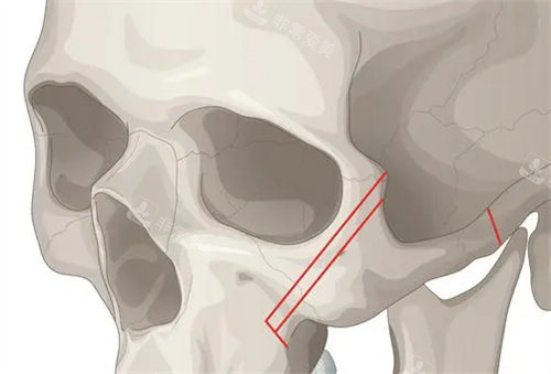 韓國(guó)菲斯萊茵整形顴骨整形示意圖