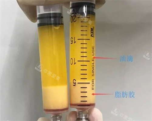 成都成美整形醫(yī)院脂肪膠示意圖