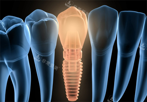 单颗种植牙展示图