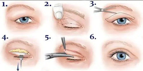 雙眼皮手術動畫示意圖