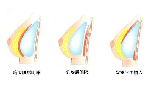 隆胸假体植入位置示意图 隆胸假体植入位置示意图