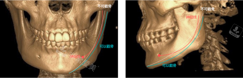 韩国TS整形医院下巴整形示意图