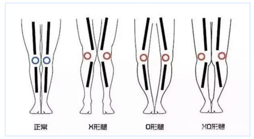 不同腿型对比