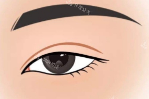 雙眼皮手術卡通圖