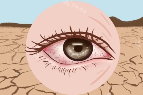 双眼皮手术卡通图
