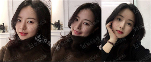 韩国id整形隆鼻术后2个月照片