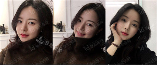 韓國id整形隆鼻術(shù)后2個月照片 韓國id整形隆鼻術(shù)后2個月照片