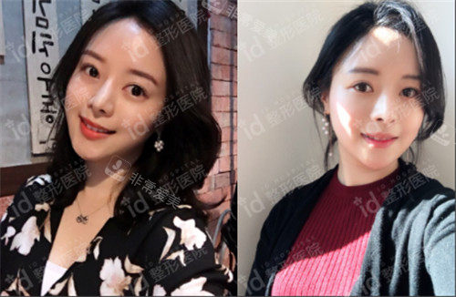 韓國id整形隆鼻8個月照片 韓國id整形隆鼻8個月照片