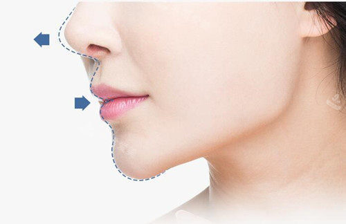 韩国温度鼻尖整形改善鼻子上翘/嘴巴突出/鼻尖低凹凸不平