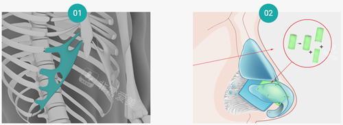 自体软骨组织隆鼻图示