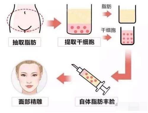 脂肪填充过程图 脂肪填充过程图