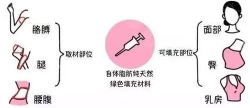 脂肪可填充部位图 脂肪可填充部位图