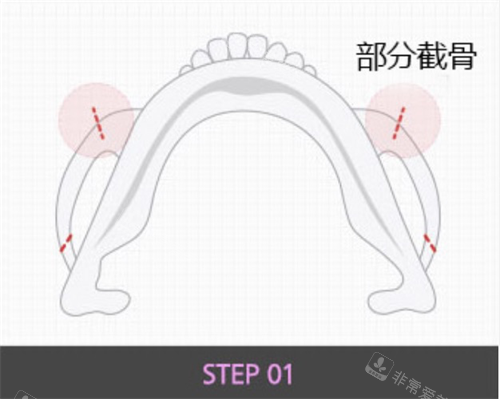 韩国格瑞丝噢爱美整形外科颧骨整形截骨部分