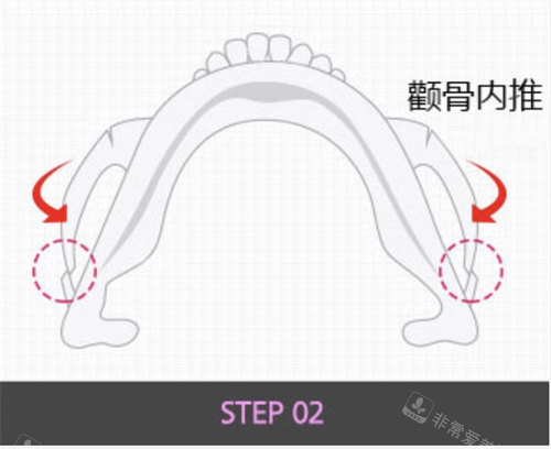 韓國格瑞絲噢愛美整形外科顴骨內(nèi)推示意圖