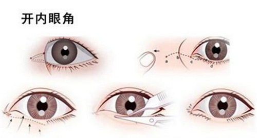 開(kāi)內(nèi)眼角示意圖 開(kāi)內(nèi)眼角示意圖
