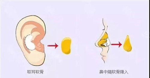 耳軟骨隆鼻示意圖